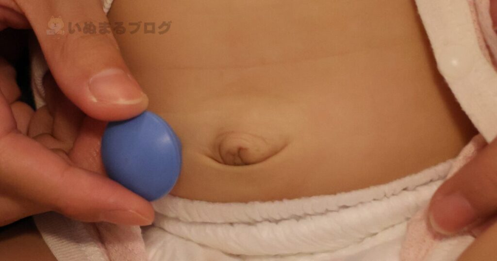 でべそ(臍ヘルニア)と圧迫療法の器具との比較