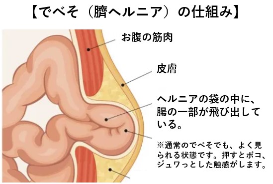 でべそ（臍ヘルニア）の仕組み引用画像