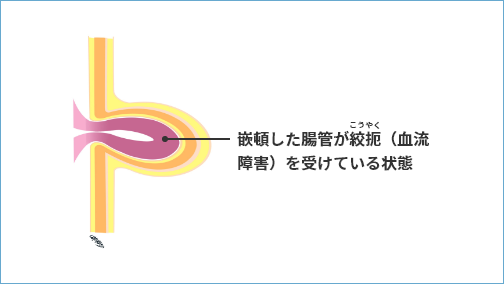 でべそ（臍ヘルニア）が嵌頓した状態ー引用画像